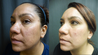 Laser Resurfacing before and after photo