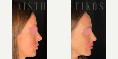 Lip Fillers before and after photo