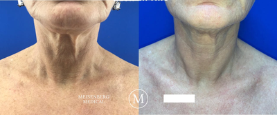 Nonsurgical Neck Lift before and after photo