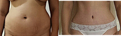 Tummy Tuck before and after photo