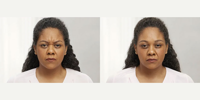 Botox before and after photo