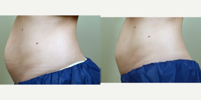 CoolSculpting before and after photo
