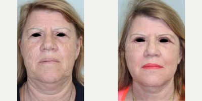 Eyelid Surgery before and after photo