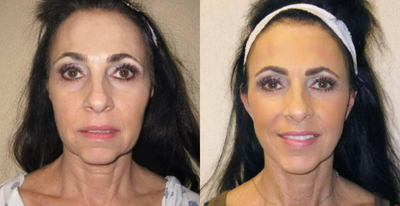 Facelift before and after photo