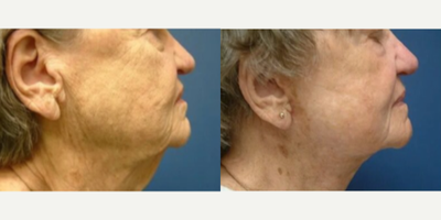 Mini Facelift before and after photo