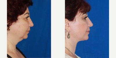 Deep Plane Facelift before and after photo