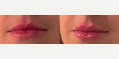 Lip Fillers before and after photo