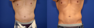 CoolSculpting before and after photo