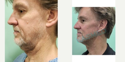 Facelift before and after photo