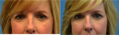 Botox before and after photo