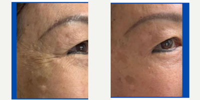 Botox before and after photo