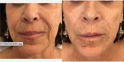 Dermal Fillers before and after photo