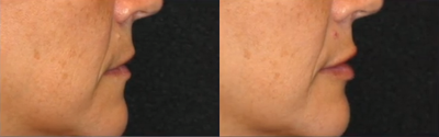 Dermal Fillers before and after photo