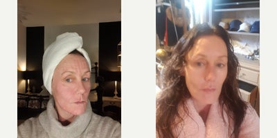 Microneedling before and after photo