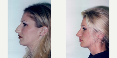 Rhinoplasty before and after photo