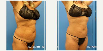 SculpSure before and after photo