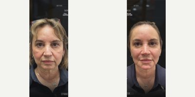 Xeomin before and after photo
