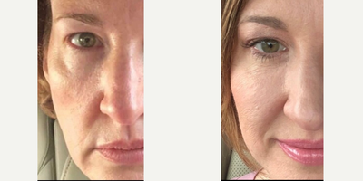Belotero before and after photo