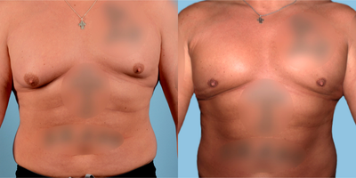 Gynecomastia Surgery before and after photo