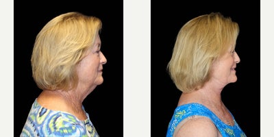 Neck Lift before and after photo