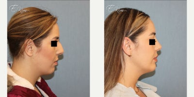 Rhinoplasty before and after photo