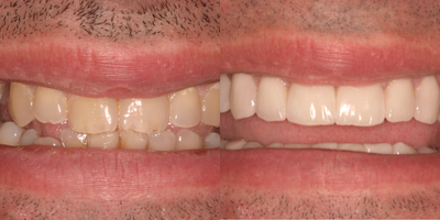 Dental Implants before and after photo
