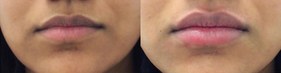 Dermal Fillers before and after photo