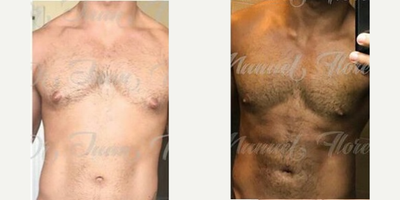 Liposuction before and after photo