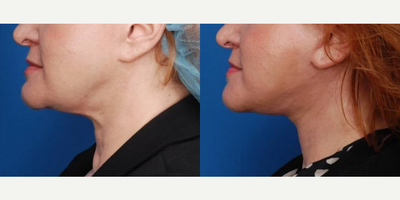 Neck Lift before and after photo