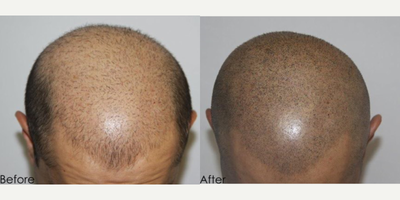 Scalp Micropigmentation before and after photo