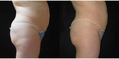 UltraShape before and after photo