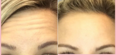 Botox before and after photo