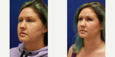 Dermal Fillers before and after photo