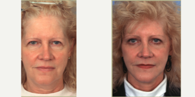 Facelift before and after photo