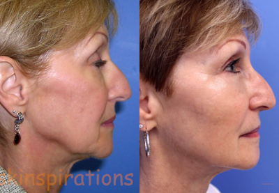 Liquid Facelift before and after photo