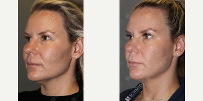 Chin Liposuction before and after photo