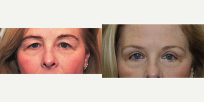 Eyelid Surgery before and after photo