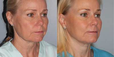 Facelift before and after photo