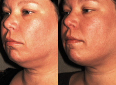 Kybella before and after photo