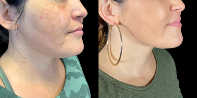 Laser Liposuction before and after photo
