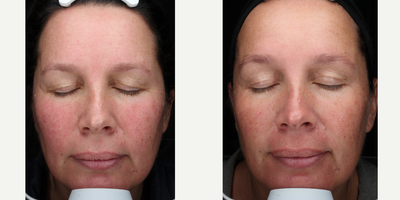 Laser Resurfacing before and after photo