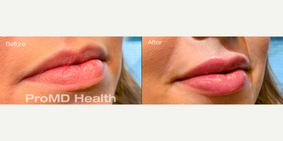 Lip Fillers before and after photo