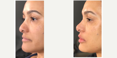 Nonsurgical Nose Job before and after photo