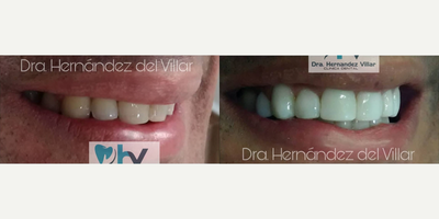 Teeth Whitening before and after photo