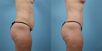 Tummy Tuck before and after photo