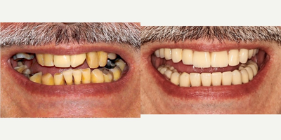 All-on-4 Dental Implants before and after photo