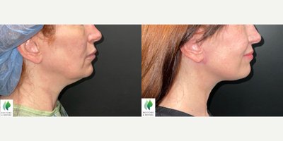 CO2 Laser before and after photo