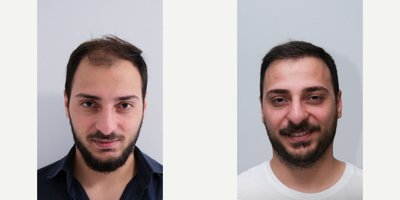 Lip Fillers before and after photo