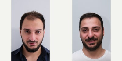 Lip Fillers before and after photo