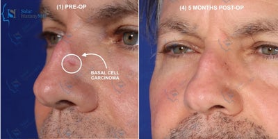 Mohs Surgery before and after photo